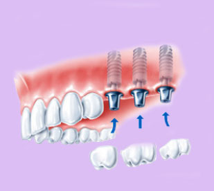 Couronnes dentaires sur implants